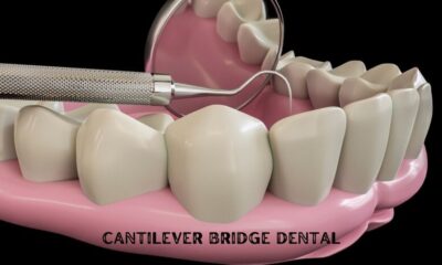 cantilever bridge dental