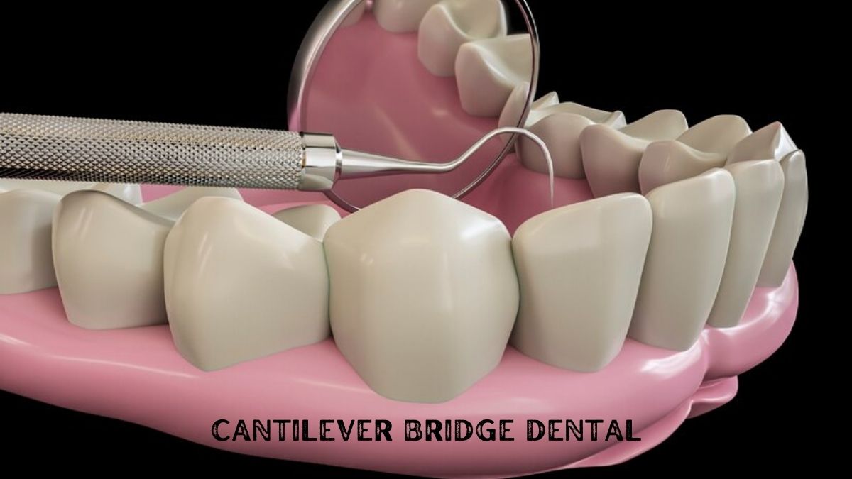 cantilever bridge dental